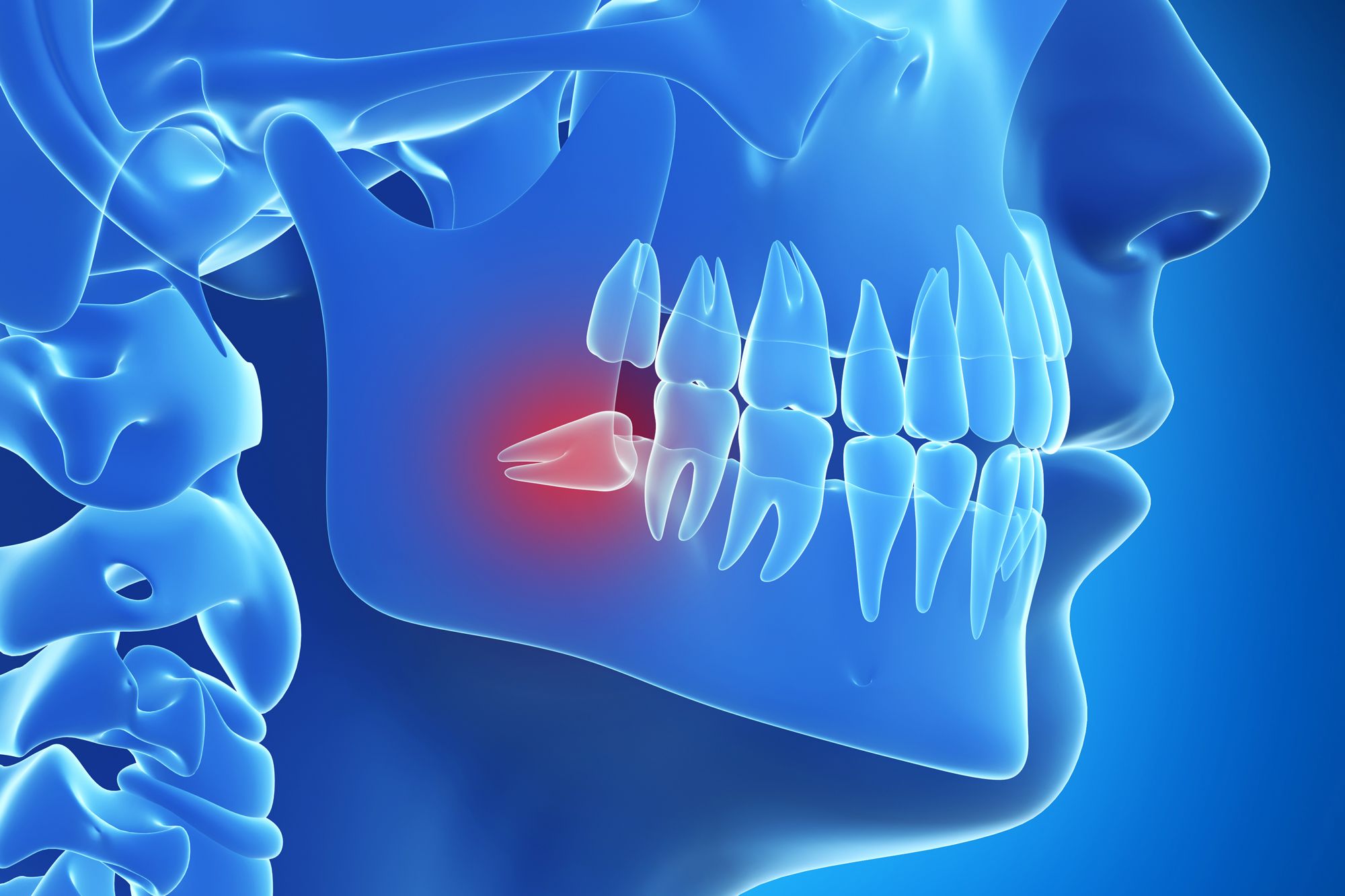 Illustration of jaw in blue with wisdom tooth in red